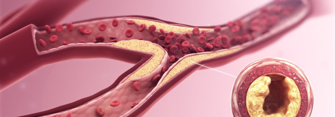 Boala Arteriala Periferica